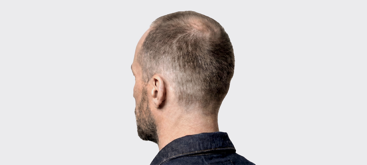 Help, mijn haar valt uit!