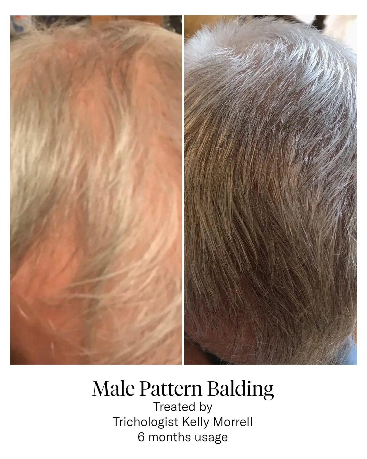 Calecim Advanced Hair System Kit